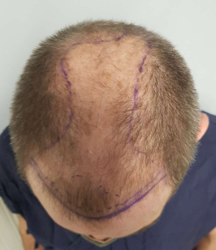 Restoration of Androgenetic Alopecia - Points of Interest