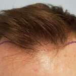 Hair transplantation at a young age. What you need to know.