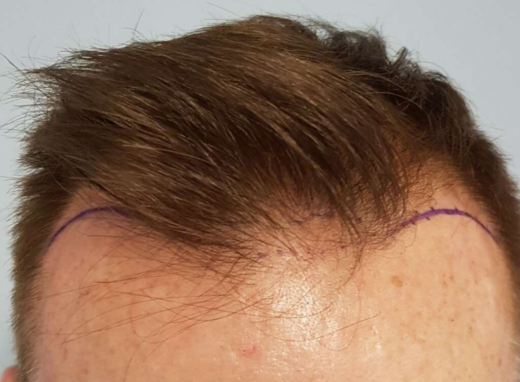 Hair transplantation at a young age. What you need to know. - Hairtrust