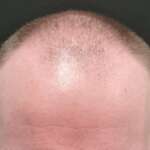 Which alopecia is indicated for hair transplantation?