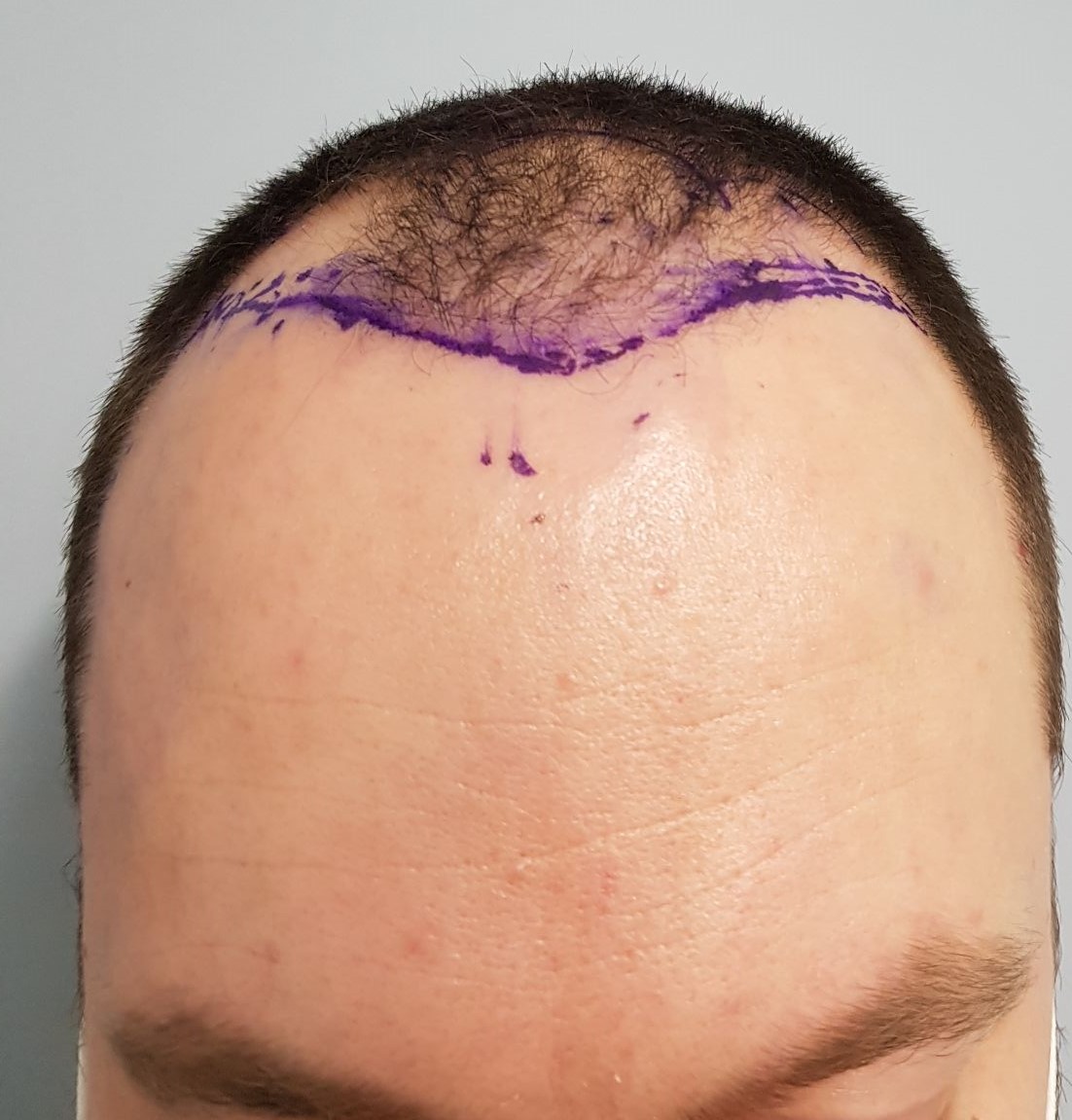 man before hair transplantation