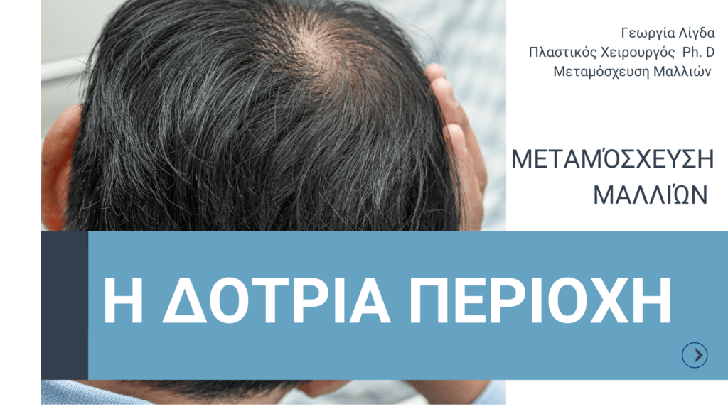 Μεταμόσχευση μαλλιών: Δότρια Περιοχή