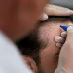 Thoughts on modification/improvement of previously restored hairline (HL)